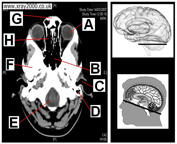 AXIAL SECTION 13.JPG